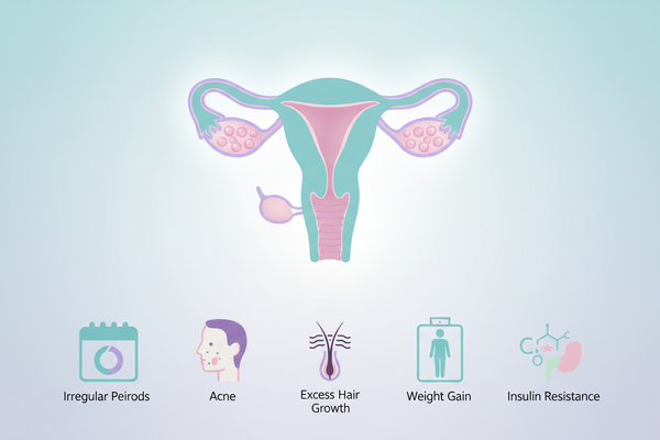 What is it like having PCOS?